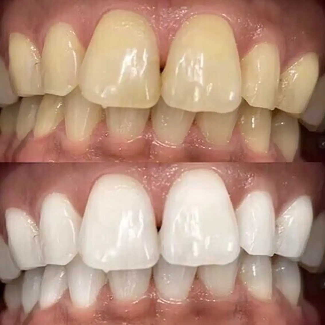 whitening-teeth_eyecatch