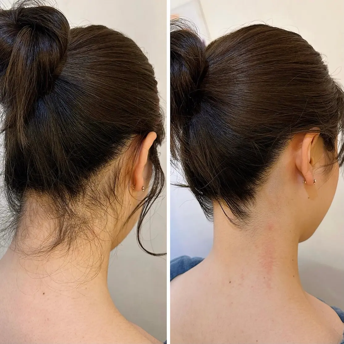 nape-of-neck-removal_eyecatch